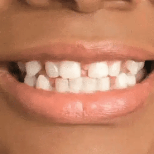 Carillas UltraFit® – Pack Completo - 😁 ¡Transforma tu Sonrisa en Segundos!